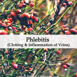 Herbal Medicine for Phlebitis (Clotting & Inflammation of Veins)