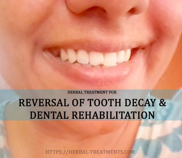 HERBAL TREATMENT FOR REVERSAL OF TOOTH DECAY & DENTAL REHABILITATION